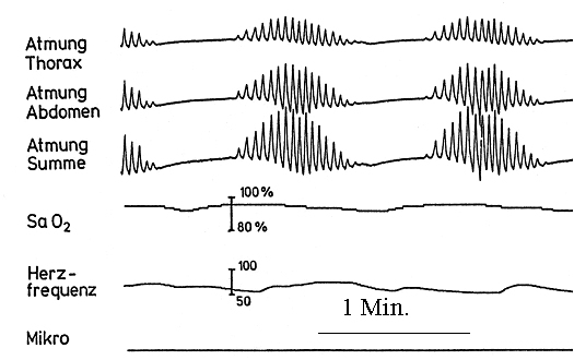 Central sleep related breathing disorders - diagnostic and therapeutic features.