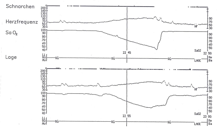 Central sleep related breathing disorders - diagnostic and therapeutic features.