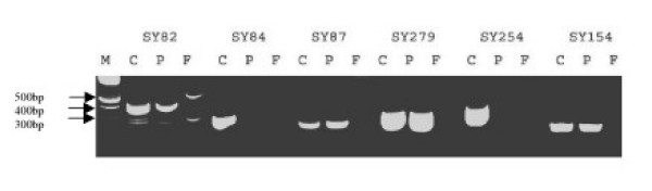 Y chromosome microdeletions in infertile men with idiopathic oligo- or azoospermia.