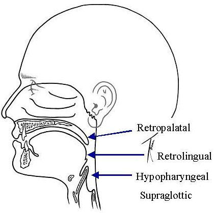 Current diagnostic trends in sleep disordered breathing.