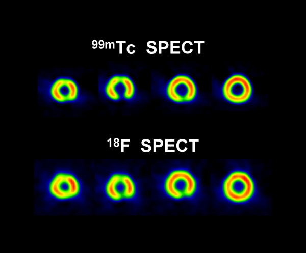 Comparison of 18F SPECT with PET in myocardial imaging: a realistic thorax-cardiac phantom study.