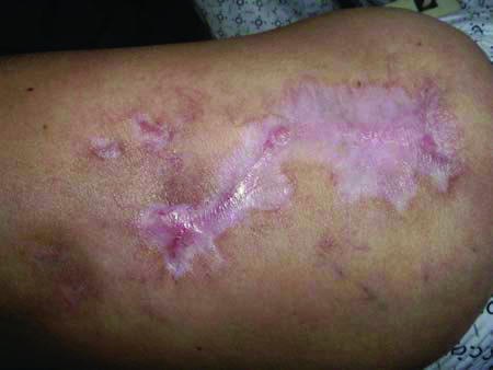 Adalimumab therapy for recalcitrant pyoderma gangrenosum.