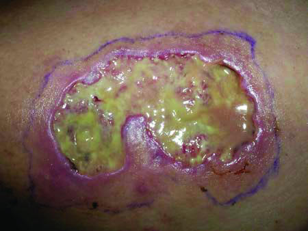 Adalimumab therapy for recalcitrant pyoderma gangrenosum.