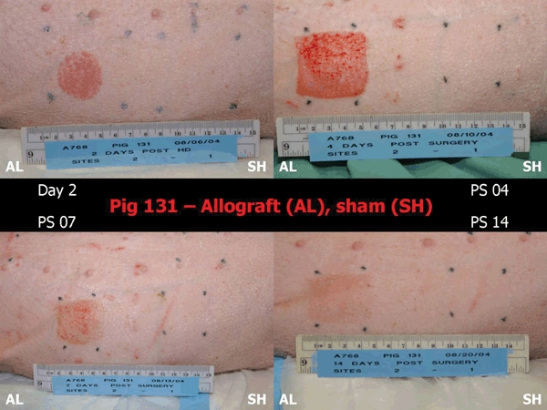 Improved wound healing of cutaneous sulfur mustard injuries in a weanling pig model.