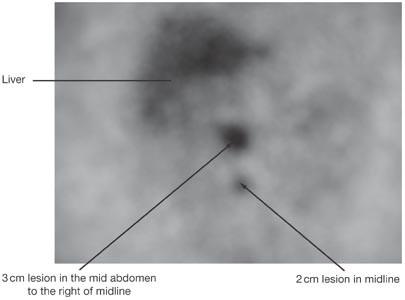 A case of familial paraganglioma syndrome type 4 caused by a mutation in the SDHB gene