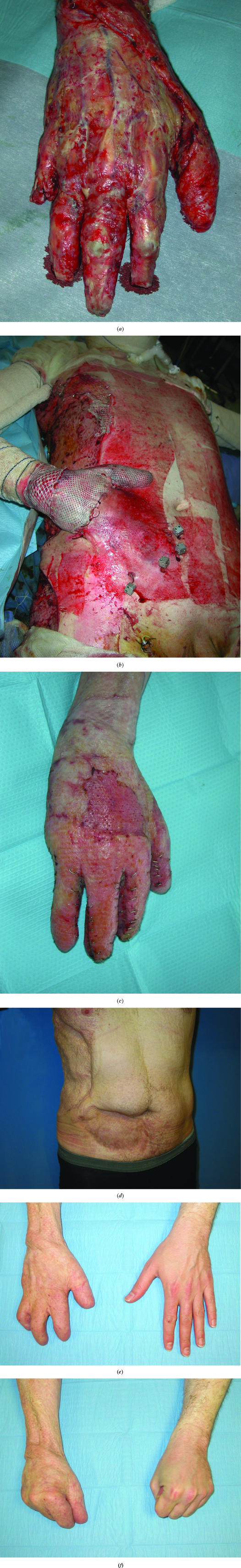 Acute deep hand burns covered by a pocket flap-graft: long-term outcome based on nine cases.