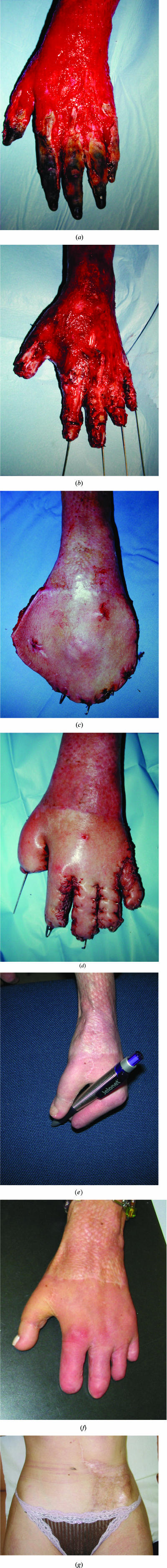 Acute deep hand burns covered by a pocket flap-graft: long-term outcome based on nine cases.