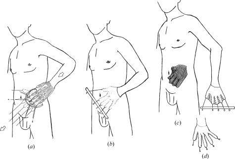 Acute deep hand burns covered by a pocket flap-graft: long-term outcome based on nine cases.