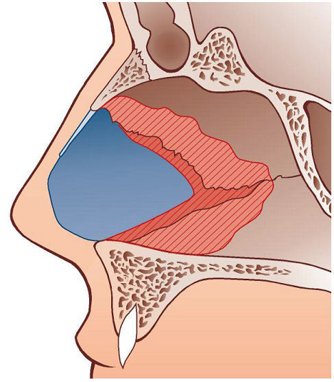Surgery of the nasal septum and turbinates.