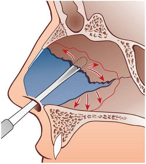 Surgery of the nasal septum and turbinates.