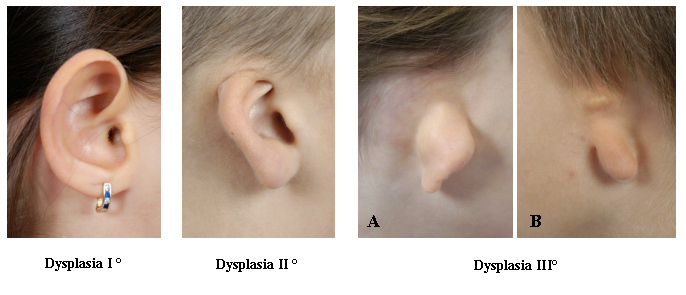 Otoplasty - techniques, characteristics and risks.