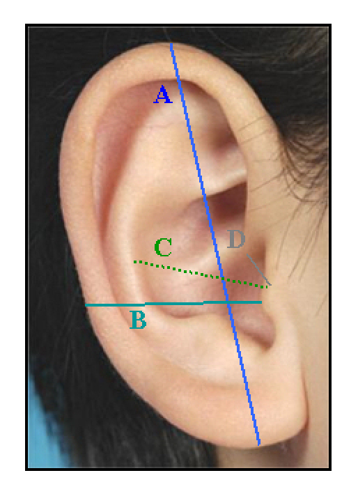 Otoplasty - techniques, characteristics and risks.