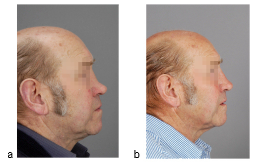 Implants for reconstructive surgery of the nose and ears.
