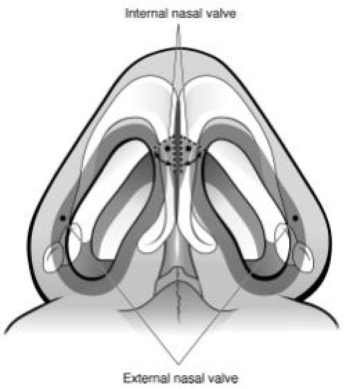 Disorders of the nasal valve area.