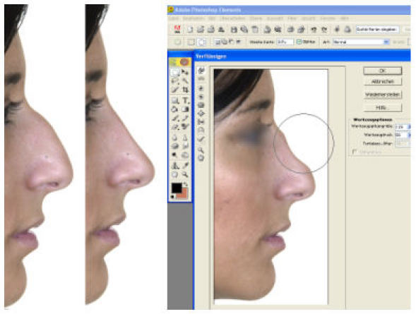 Rhinoplasty - indications and techniques.