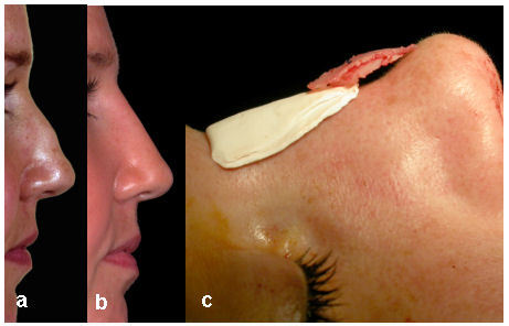 Rhinoplasty - indications and techniques.