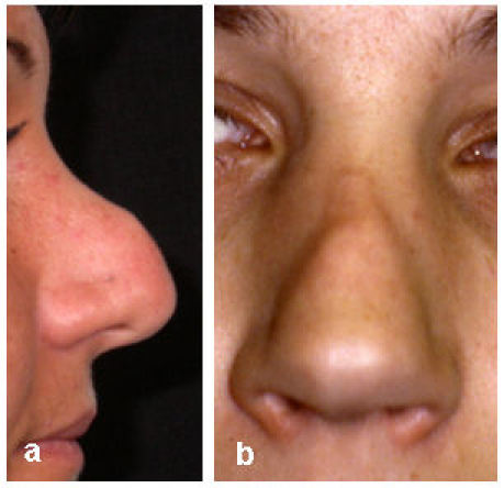 Rhinoplasty - indications and techniques.