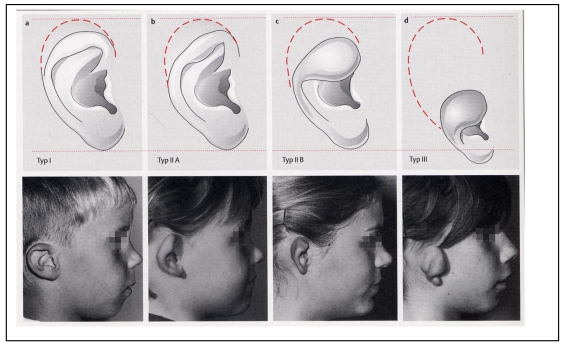 Classification and diagnosis of ear malformations.