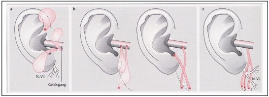 Classification and diagnosis of ear malformations.