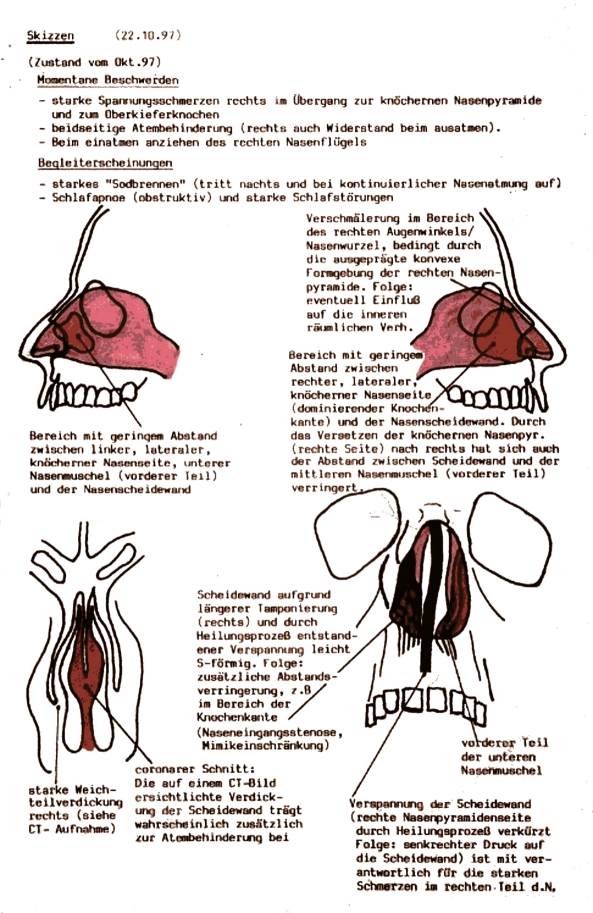 Risks and complications in rhinoplasty.