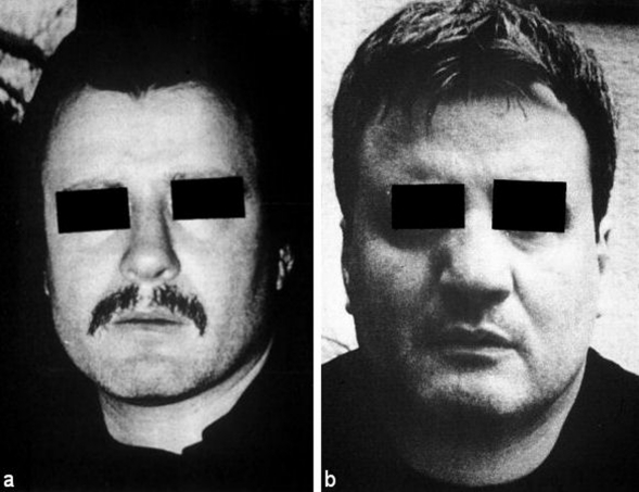 Risks and complications in rhinoplasty.
