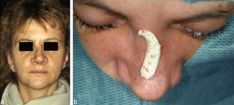 Risks and complications in rhinoplasty.