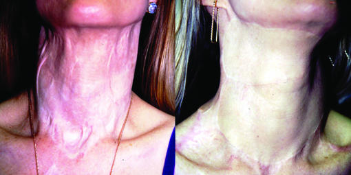 Expanded transposition flap technique for total and subtotal resurfacing of the face and neck.