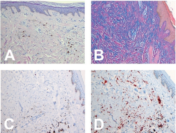 Sclerosing 'mucinous' blue nevus: a clinical simulator of dermatofibroma.