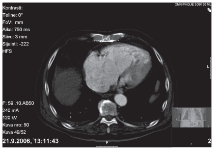 Primary osteosarcoma of the right heart ventricle and atrium; a case report.