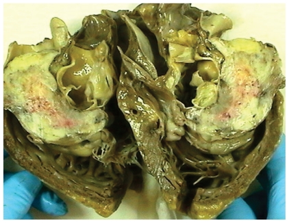 Primary osteosarcoma of the right heart ventricle and atrium; a case report.