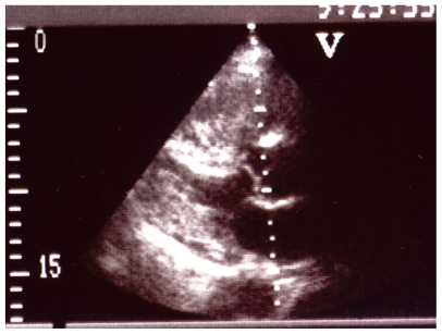 Primary osteosarcoma of the right heart ventricle and atrium; a case report.