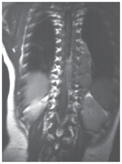 Chromosome 1p and 11q deletions and outcome in neuroblastoma-a critical review.