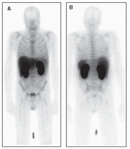 Radionuclide Imaging of Apoptosis in Malignancies: Promise and Pitfalls of Tc-Hynic-rh-Annexin V Imaging.