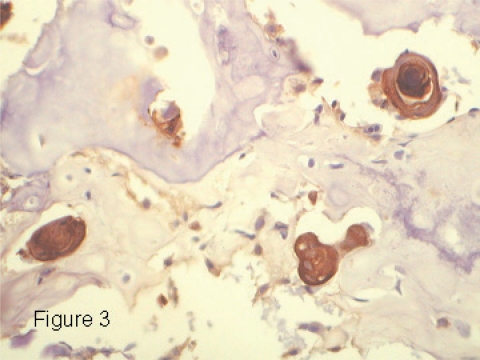 Squamous differentiation and cytokeratin expression in an osteosarcoma: a case report and review of the literature.