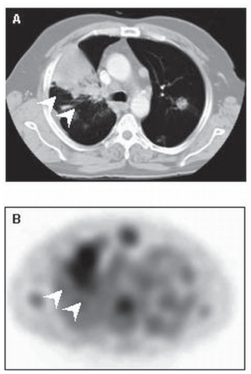 Radionuclide Imaging of Apoptosis in Malignancies: Promise and Pitfalls of Tc-Hynic-rh-Annexin V Imaging.