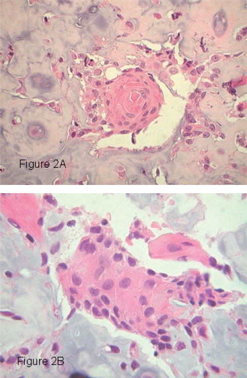 Squamous differentiation and cytokeratin expression in an osteosarcoma: a case report and review of the literature.