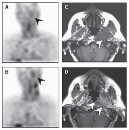 Radionuclide Imaging of Apoptosis in Malignancies: Promise and Pitfalls of Tc-Hynic-rh-Annexin V Imaging.