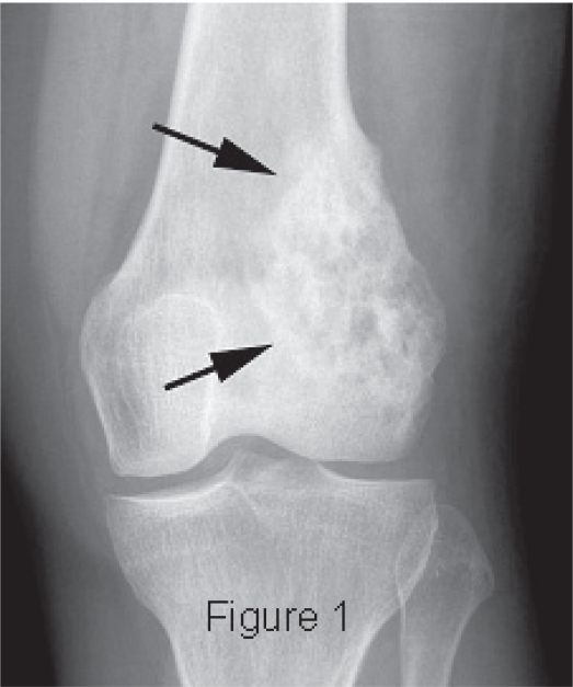 Squamous differentiation and cytokeratin expression in an osteosarcoma: a case report and review of the literature.