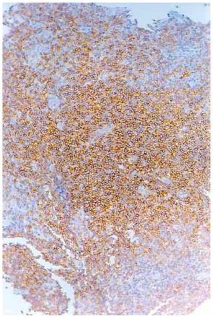 Primary MALT Type Skin Lymphoma-Is 'Wait and See' a Possible Strategy?