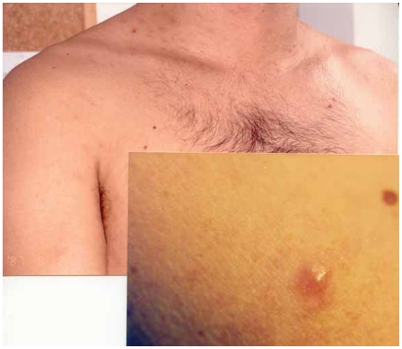 Primary MALT Type Skin Lymphoma-Is 'Wait and See' a Possible Strategy?