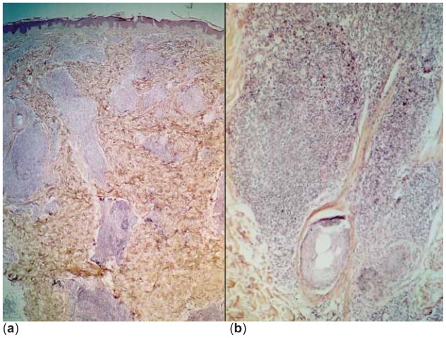 Primary MALT Type Skin Lymphoma-Is 'Wait and See' a Possible Strategy?