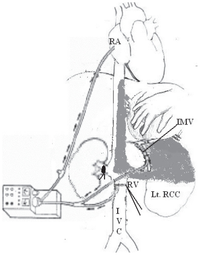 Renal Cell Carcinoma with IVC Thrombi; Current Concepts and Future Perspectives.