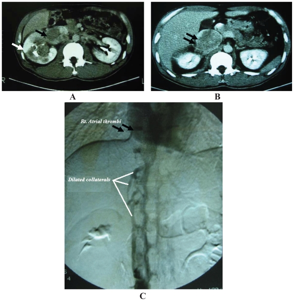 Renal Cell Carcinoma with IVC Thrombi; Current Concepts and Future Perspectives.