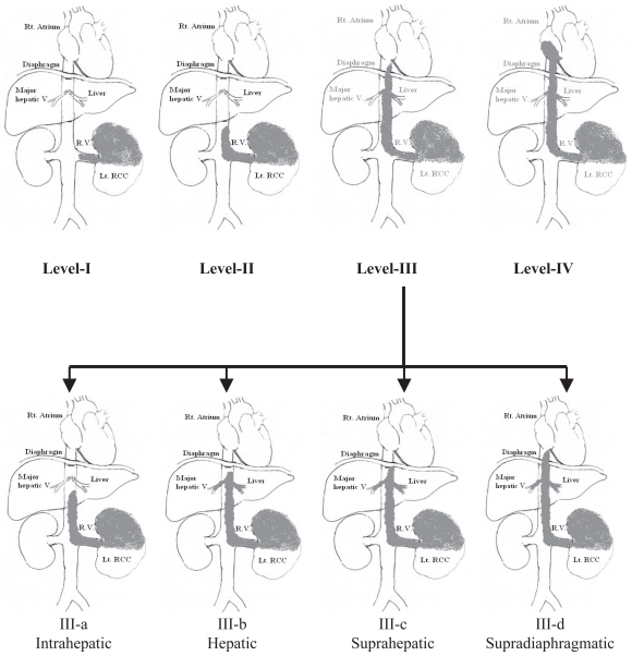 Renal Cell Carcinoma with IVC Thrombi; Current Concepts and Future Perspectives.