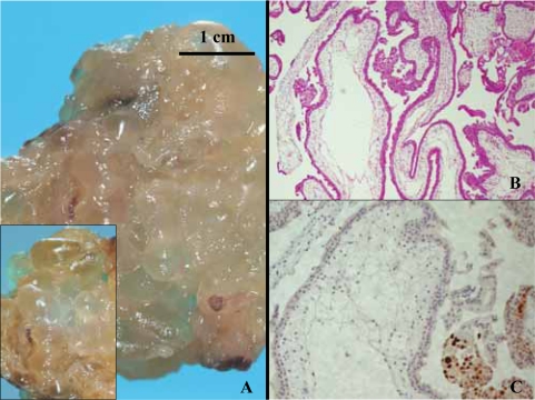 Combination of immunohistochemistry and ploidy analysis to assist histopathological diagnosis of molar diseases.