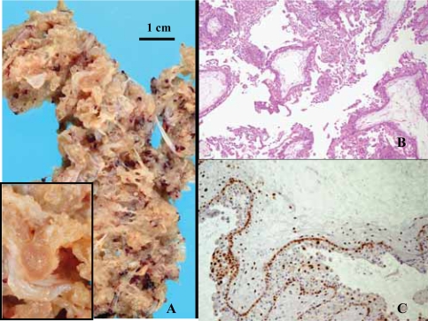 Combination of immunohistochemistry and ploidy analysis to assist histopathological diagnosis of molar diseases.