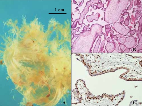 Combination of immunohistochemistry and ploidy analysis to assist histopathological diagnosis of molar diseases.