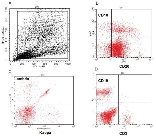 The presence of precursors of benign pre-B lymphoblasts (hematogones) in the bone marrow of a paediatric patient with cytomegalovirus infection.