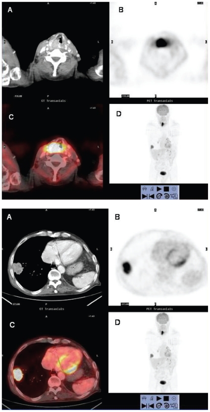 Integrated FDG PET/CT: Utility and Applications in Clinical Oncology.