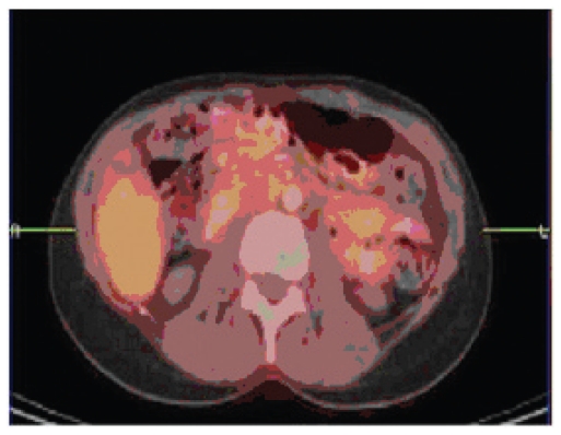 Documentation of complete response in metastatic breast cancer to liver and bone achieved with trastuzumab and pegylated liposomal Doxorubicin.